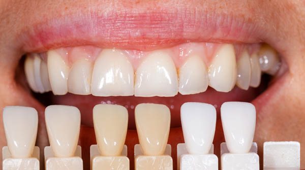 How Long Does Teeth Whitening From A Dentist Last?